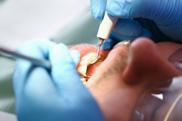 Best Emergency Tooth Extraction in Noyack, NY